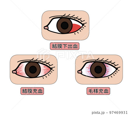 結膜下出血・結膜充血・毛様充血 97469931