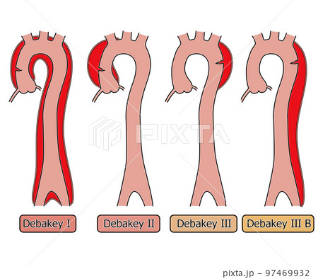 大動脈解離　DeBakey分類 97469932