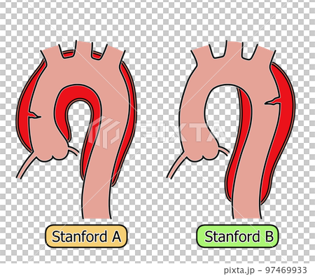 大動脈解離　Stanford分類 97469933