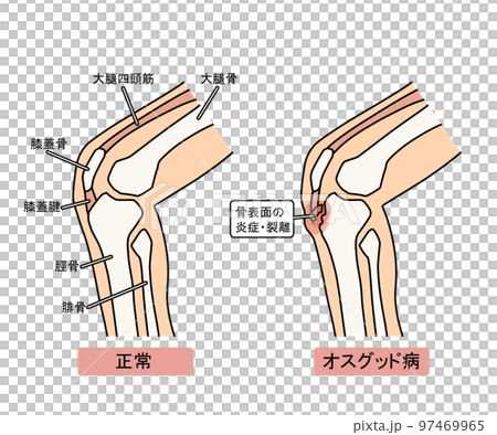 奧斯古德病 97469965
