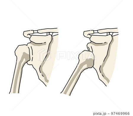 肩関節脱臼 97469966