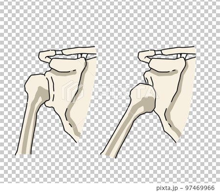 Shoulder joint dislocation 97469966
