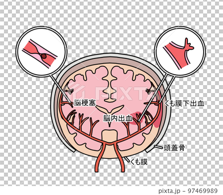 腦血管疾病 97469989