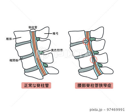 腰部脊柱管狭窄症 腰部脊柱管狭窄症 97469991