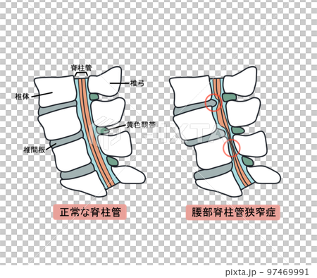 腰部脊柱管狭窄症 腰部脊柱管狭窄症 97469991