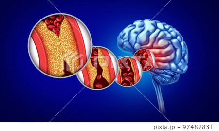 Stroke And Atherosclerosisのイラスト素材 [97482831] - PIXTA
