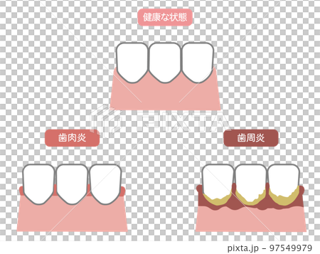 健康牙齒、牙周病和牙齦炎的例證 2 97549979