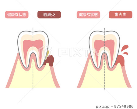 健康な歯、歯周病、歯肉炎のイラスト1 97549986