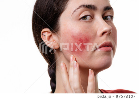 Close up portrait of a young Caucasian woman in close-up showing rosacea on her cheeks with her hand. White background. Rosacea and inflammation on the face 97573107