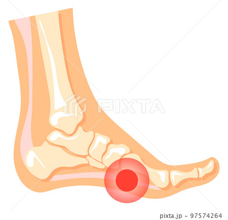 Leg pain. Red spot in human foot. Medical illustration Leg pain. Red spot in human foot. Medical illustration 97574264