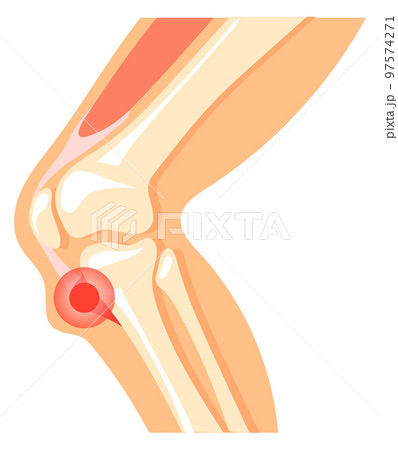Knee pain icon. Leg anatomy with red spot 97574271
