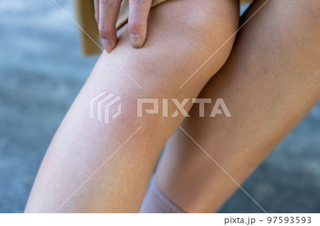 Woman sit on the bench at park with suffers from mosquito bite Woman sit on the bench at park with suffers from mosquito bite 97593593