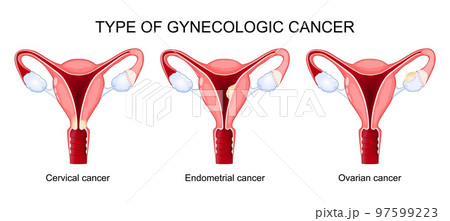 Type of gynecologic cancer. Ovarian, Endometrial, and Cervical cancer. Type of gynecologic cancer. Ovarian, Endometrial, and Cervical cancer. 97599223