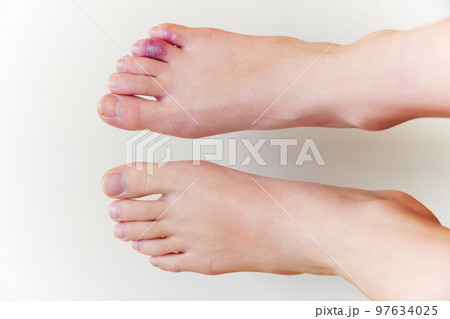 しもやけになった子どもの足 しもやけになった子どもの足 97634025