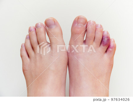 しもやけになった子どもの足 しもやけになった子どもの足 97634026