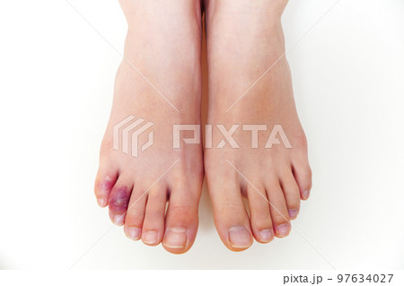 しもやけになった子どもの足 しもやけになった子どもの足 97634027