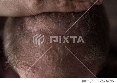 Men hair loss problem alopecia 97678745