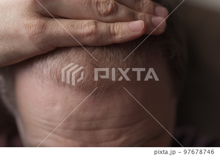 Men hair loss problem alopecia 97678746