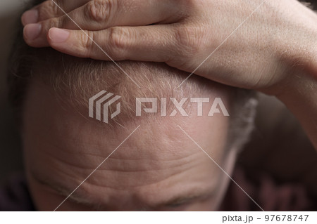 Men hair loss problem alopecia Men hair loss problem alopecia 97678747