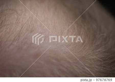 Men hair loss problem alopecia 97678769