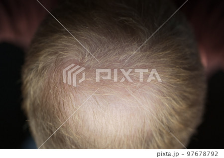 Men hair loss problem alopecia 97678792
