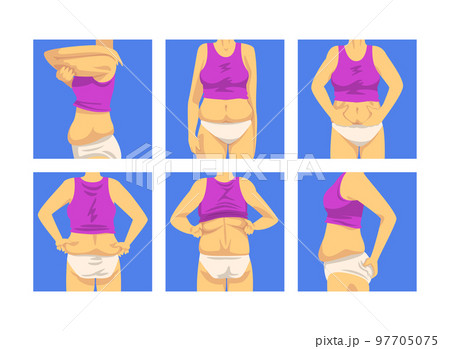 Female Torso with Sagging Belly and Soft Muscles Vector Set Female Torso with Sagging Belly and Soft Muscles Vector Set 97705075
