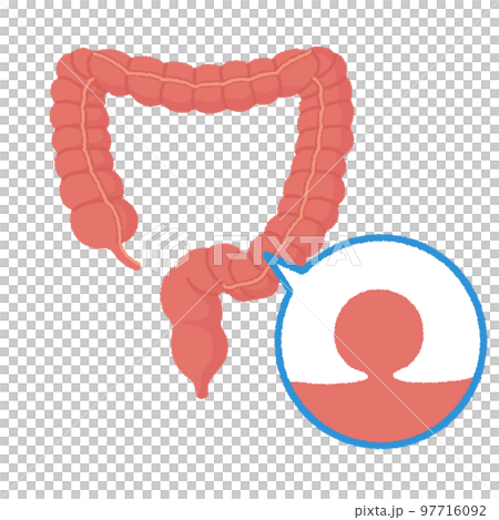 Illustration of colon polyps 97716092