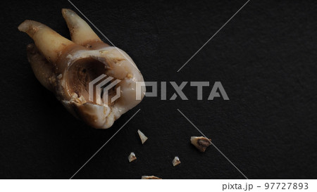 Tooth decay on black background. Macro shot of a decayed teeth till root after extraction of dentist. Real tooth anatomy due lack of care. Top view of caries teeth texture on black paper. Dental care. 97727893