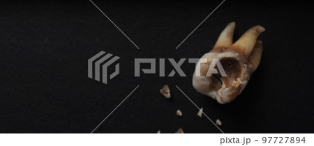 Tooth decay on black background. Macro shot of a decayed teeth till root after extraction of dentist. Real tooth anatomy due lack of care. Top view of caries teeth texture on black paper. Dental care. 97727894