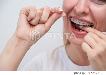 Caucasian woman cleaning her teeth with braces using dental floss.  97747886