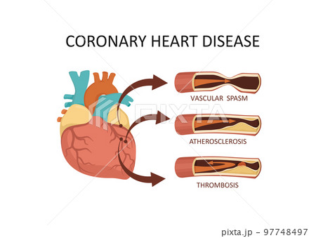Coronary heart disease. Heart attack - atherosclerosis, thrombus, spasm, 97748497