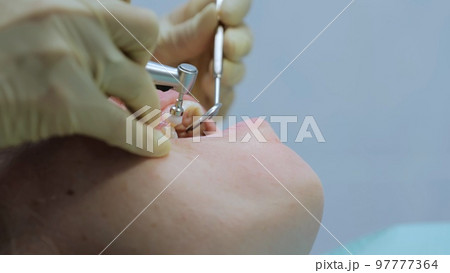 Woman cleaning teeth at the dentist. Dentist brushing teeth. Teeth whitening. Extreme shot of female teeth polishing with professional dental equipment. Dentist visit 97777364