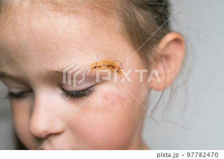 Close up sad, brave, drear cropped girl face with stitches on scratch of eyebrow dissection, looking down. Medicine aid Close up sad, brave, drear cropped girl face with stitches on scratch of eyebrow dissection, looking down. Medicine aid 97782470