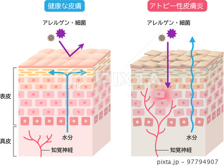アトピー性皮膚炎と健康な皮膚　肌細胞と断面図 立体 97794907