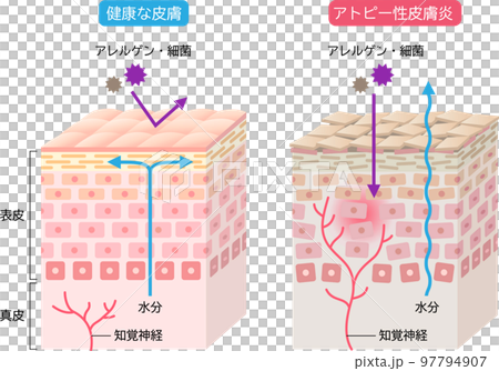 アトピー性皮膚炎と健康な皮膚　肌細胞と断面図 立体 97794907