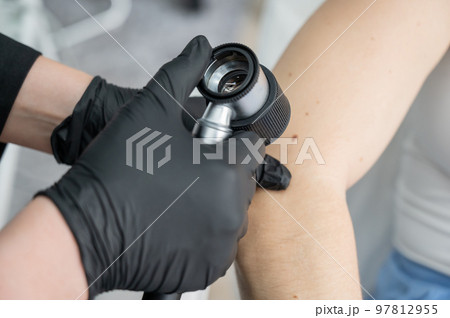 A dermatologist examines a patient's mole through a dermatoscope. A dermatologist examines a patient's mole through a dermatoscope. 97812955