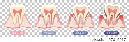 Tooth illustration_progression of periodontal disease 97816017