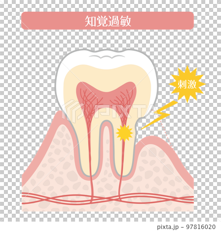 牙齒插圖_過敏 牙齒插圖_過敏 97816020