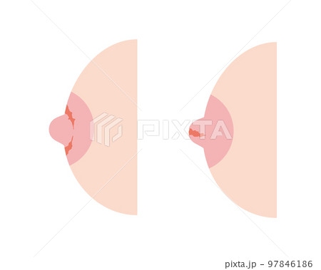 乳首亀裂が起こった女性の胸 乳首亀裂が起こった女性の胸 97846186