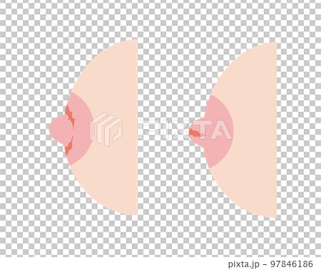 Female breasts with cracked nipples 97846186