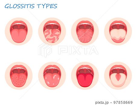 Types Glossitis. Inflammatory Disease Tongue,...のイラスト素材 [97858669] - PIXTA