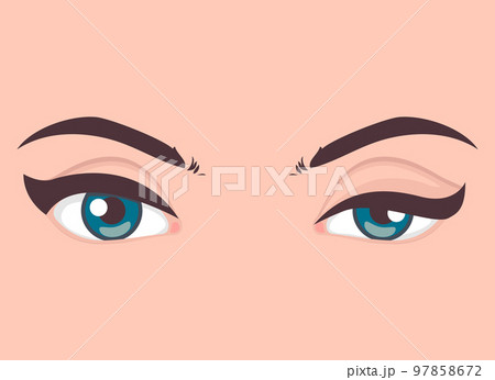 Ptosis of the upper eyelid, optical problem with eye, medical vector illustration 97858672