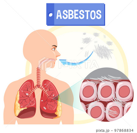 Diagram showing asbestosis in lungs 97868834