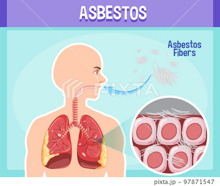 Diagram showing asbestosis in lungs 97871547