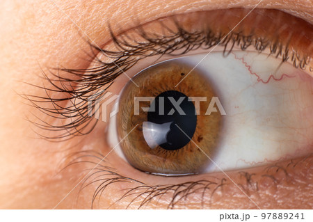 Keratoconus of eye, 4th degree. Contortion of the cornea in the form of a cone, deterioration of vision, astigmatism. Macro close up Keratoconus of eye, 4th degree. Contortion of the cornea in the form of a cone, deterioration of vision, astigmatism. Macro close up 97889241