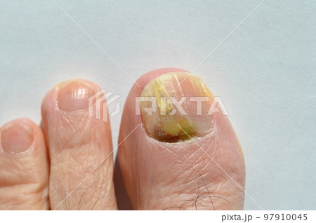 爪の異常 97910045