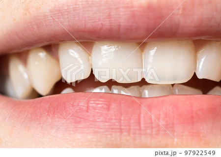 Macro close-up of human teeth. Shows the chipped tooth. The effect of the cutter's tooth from biting the seeds shell and solid food. For dentists, dental clinics - aesthetic minor damage. Macro close-up of human teeth. Shows the chipped tooth. The effect of the cutter's tooth from biting the seeds shell and solid food. For dentists, dental clinics - aesthetic minor damage. 97922549