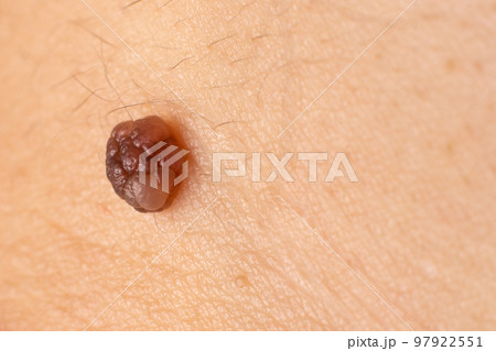 Mole birthmark nevus macro photo on human skin. Close up. Mole birthmark nevus macro photo on human skin. Close up. 97922551
