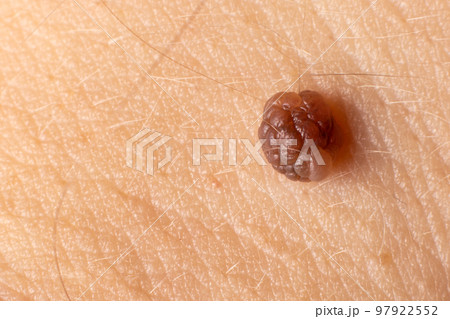 Mole birthmark nevus macro photo on human skin. Close up. 97922552