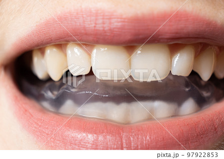 Dental mouthguard, splint in the mouth for the treatment of dysfunction of the temporomandibular joints, bruxism, malocclusion, to relax the muscles of the jaw. 97922853